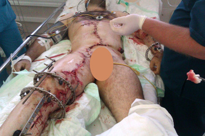 В первые недели лечения, когда ногу ещё пытались спасти