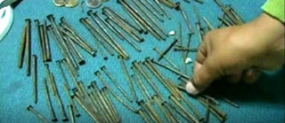 Гвозди из желудка Перуанца - кадр Associated Press